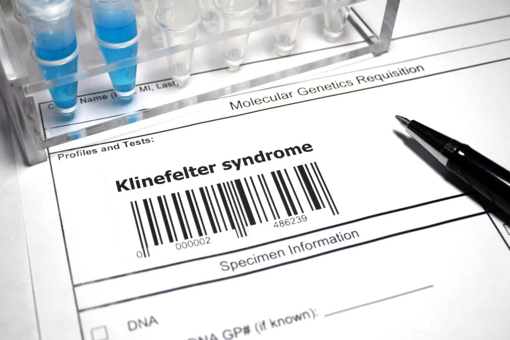 What is the Frequency of Infertility in Klinefelter Syndrome?